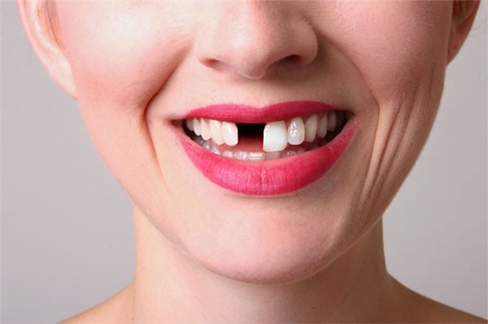 Gãy răng đánh số mấy thì dễ trúng lô đề hiệu quả?